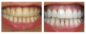 free teeth whitening kits photo 2