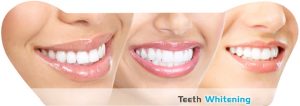 free teeth whitening kits photo 3