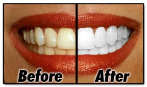 Get Free Teeth Whitening Samples